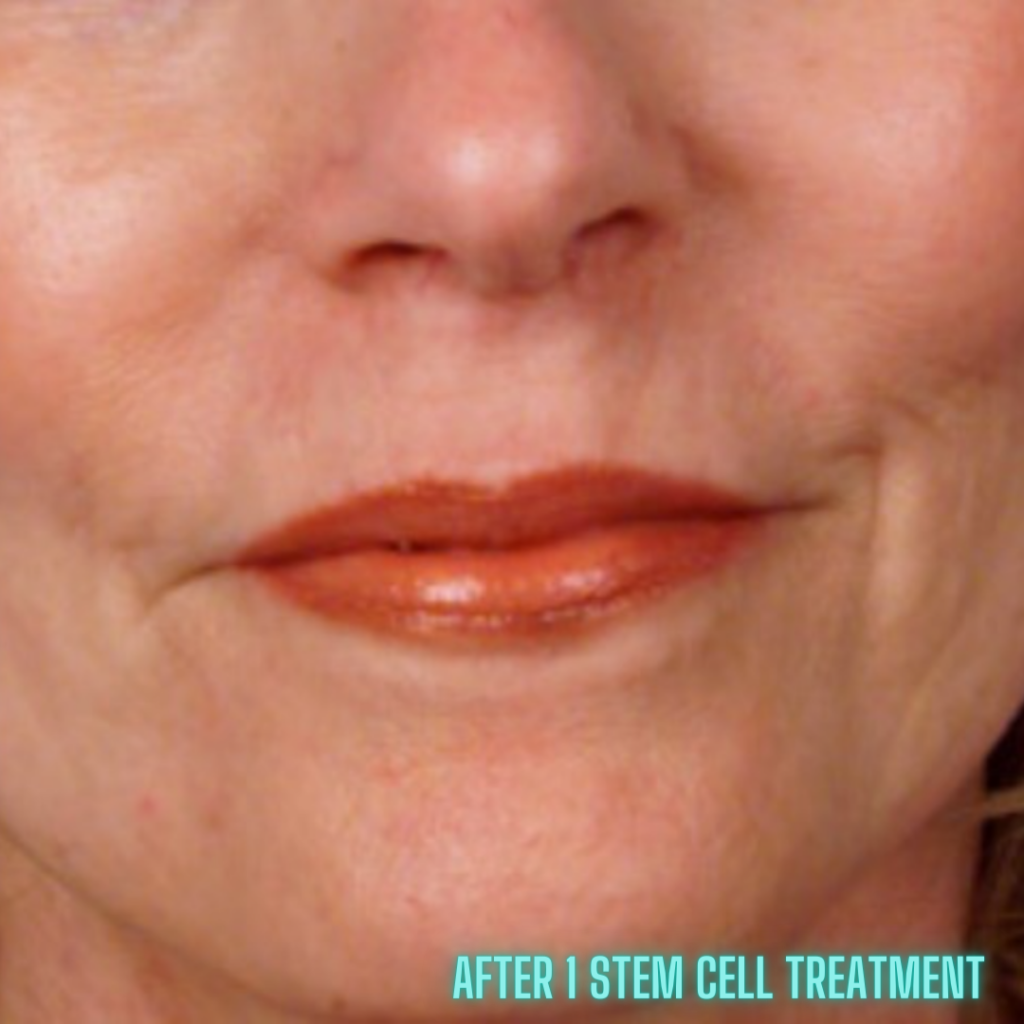 image of after a stem cell facial