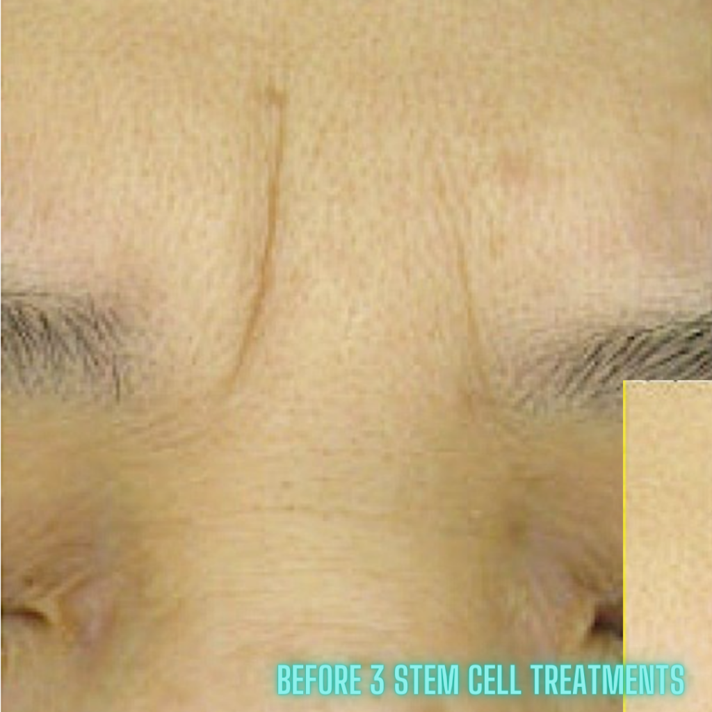 image of before a stem cell facial