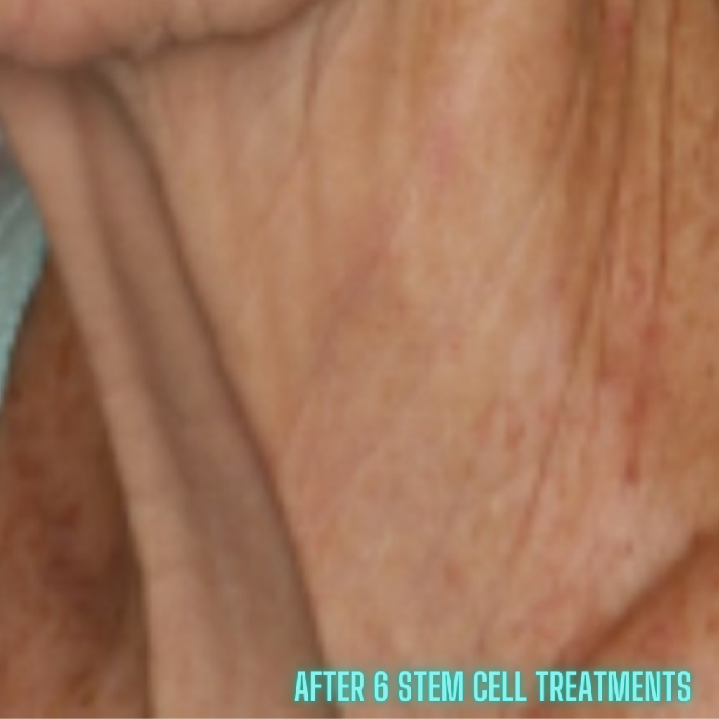 image of after a stem cell facial