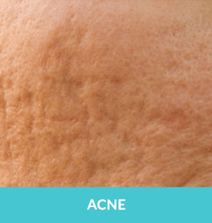 skincare-services > Acne