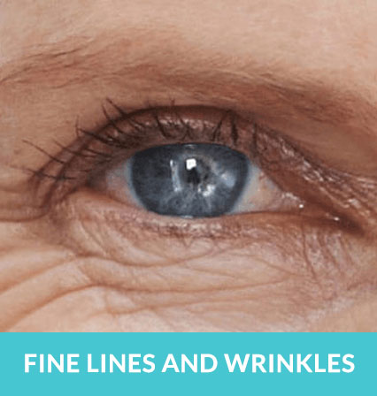 skincare-services > Fine Lines and Wrinkles