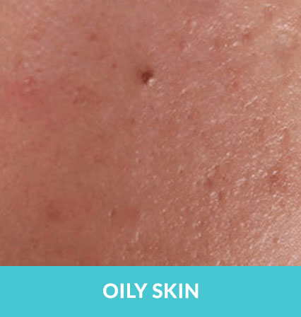 skincare-services > Oily Skin