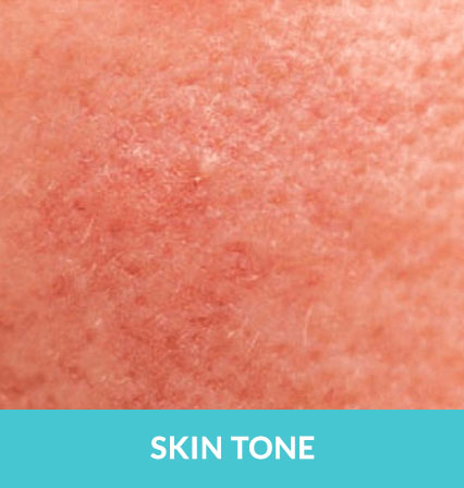skincare-services > Skin Tone