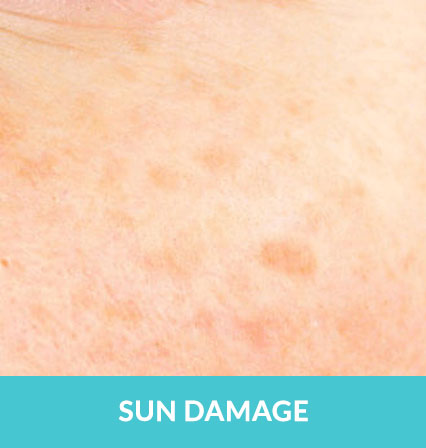 skincare-services > Sun Damage