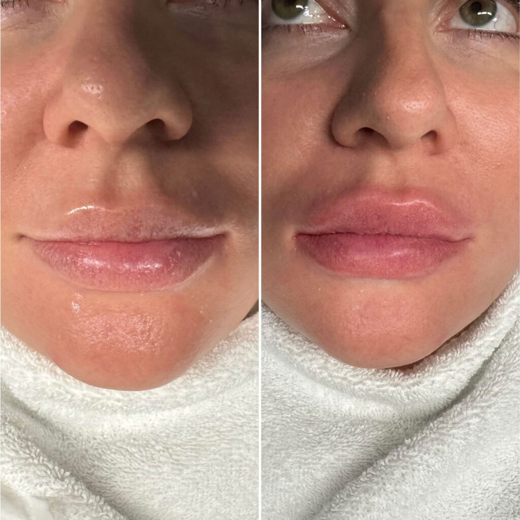 beauty services permanent makeup - lips: snow lips